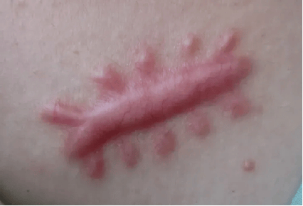 手部瘢痕干预时间_手部瘢痕防治措施_疤痕体质如何去除