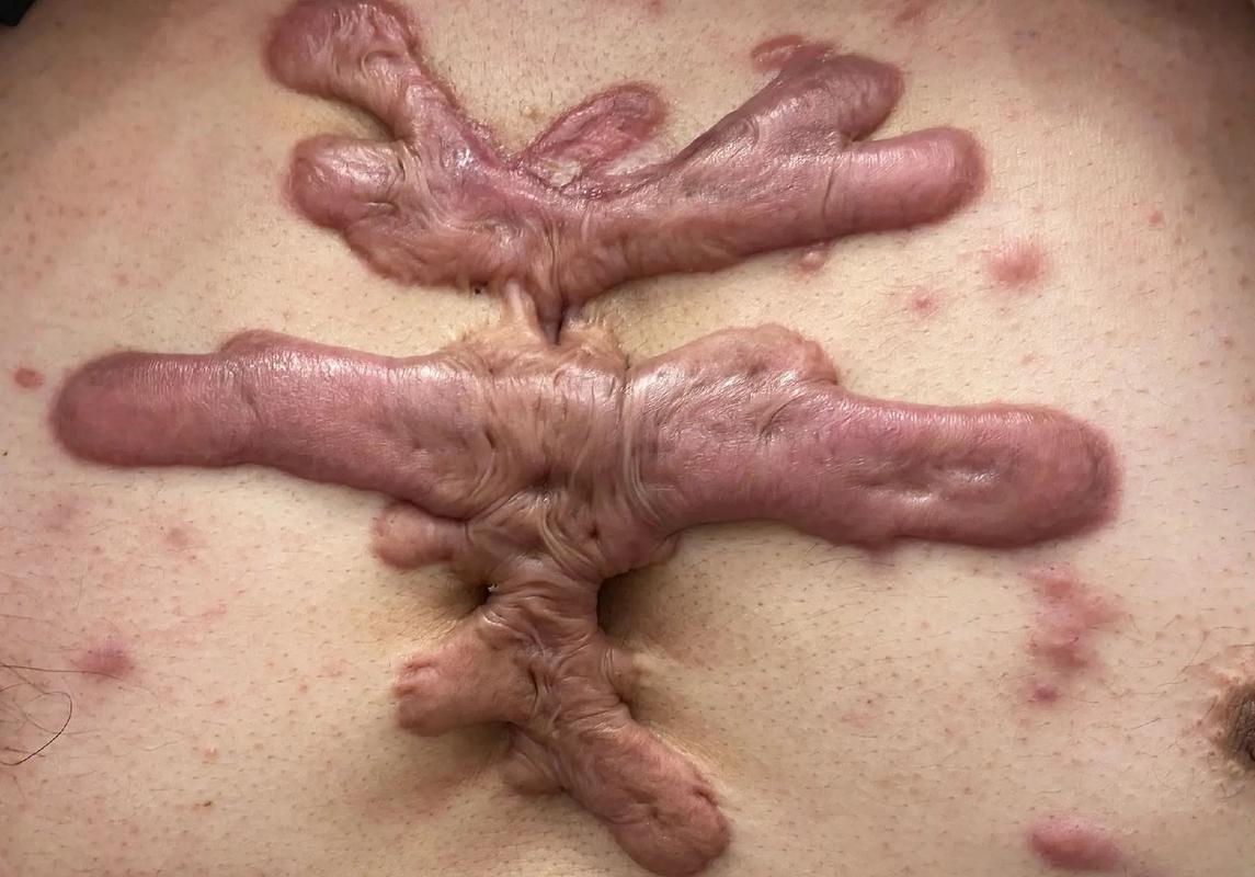 疤痕体质如何去除_瘢痕体质纹身风险_瘢痕体质是什么特征